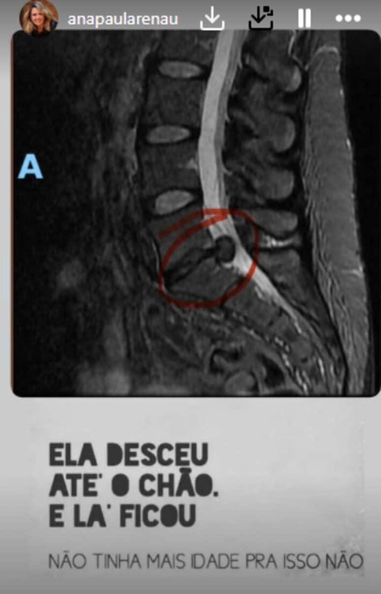 Ana Paula Renault mostra sua h&eacute;rnia de disco