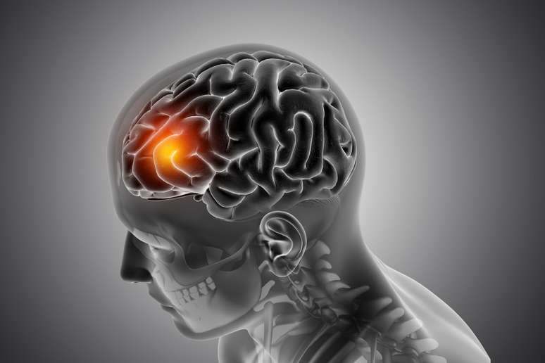 Is the brain aneurysm hereditary? Understand the risk factors Is the brain aneurysm hereditary? Understand the risk factors