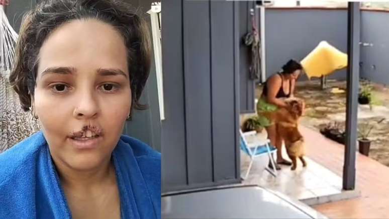 Natani Santos depois da mordida do seu cachorro Jacke, de 5 anos