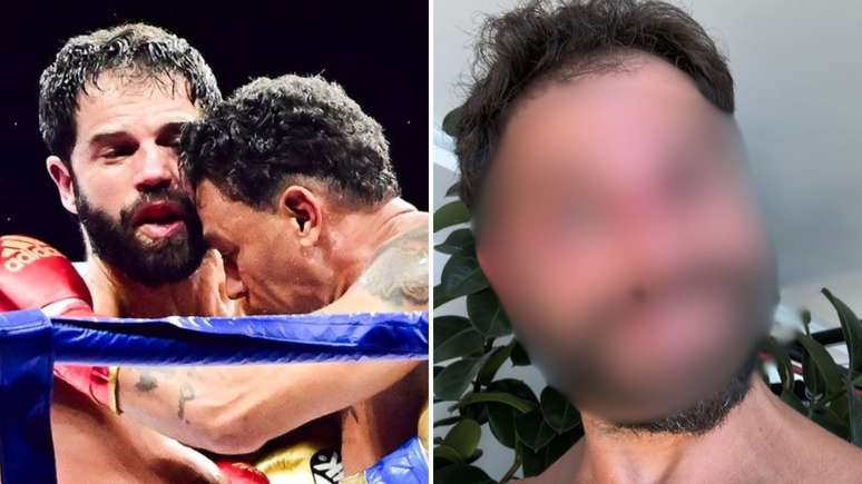 Duda Nagle surge com o rosto 'desconfigurado' após luta com Popó: 'Mão de pedra'