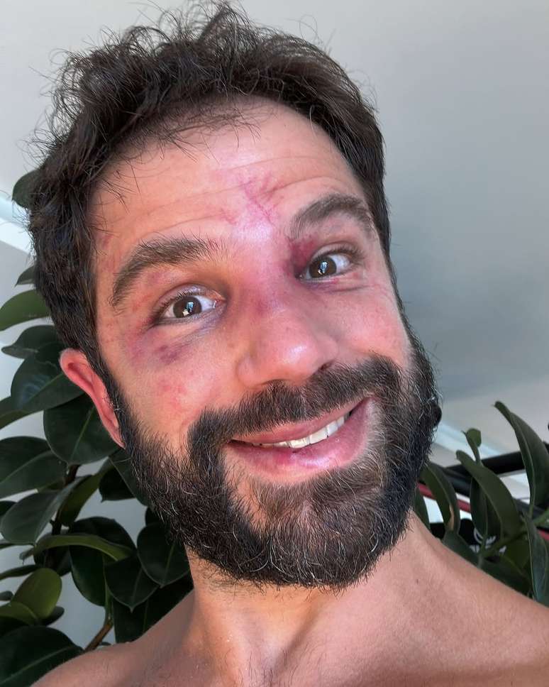 Duda Nagle shows bruises after the struggle with Popó Duda Nagle shows bruises after the struggle with Popó