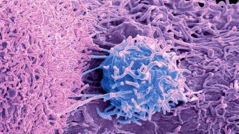 As células cancerosas (em azul) podem ser desprender do tumor e afetar outras partes do corpo, num processo conhecido como metástase
