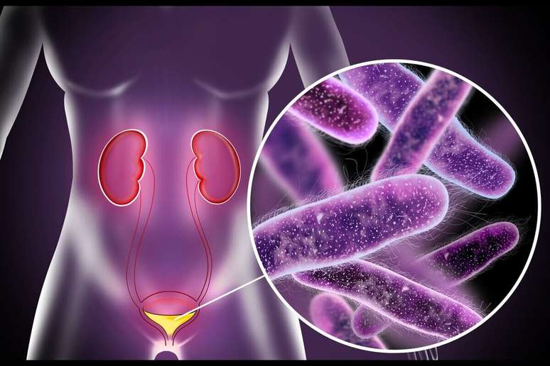Aroeira contains substances that inhibit bacteria responsible for the cause of the urinary tract infection 