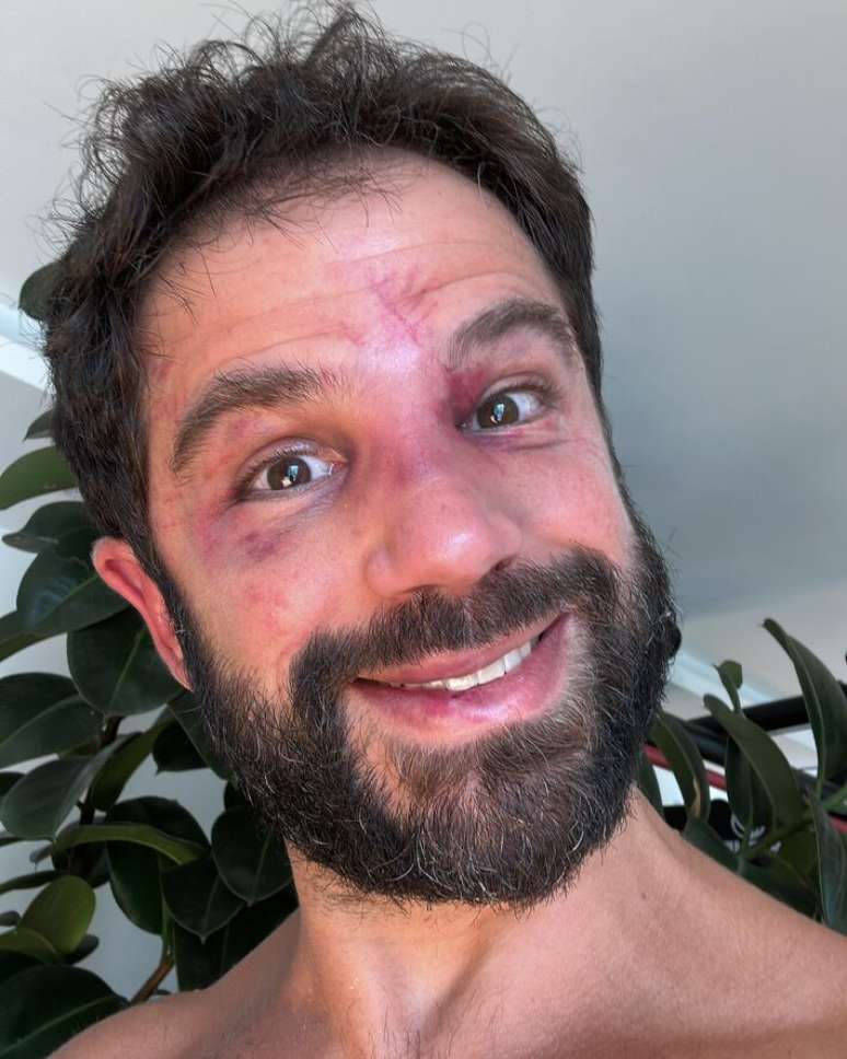 Duda Nagle mostra hematomas ap&oacute;s perder luta para Pop&oacute;