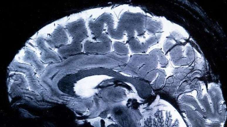 O c&eacute;rebro possui ventr&iacute;culos, pequenas c&acirc;maras onde o fluido cerebroespinhal pode se acumular