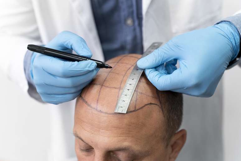Who can make hair transplantation? The tricologist explains!