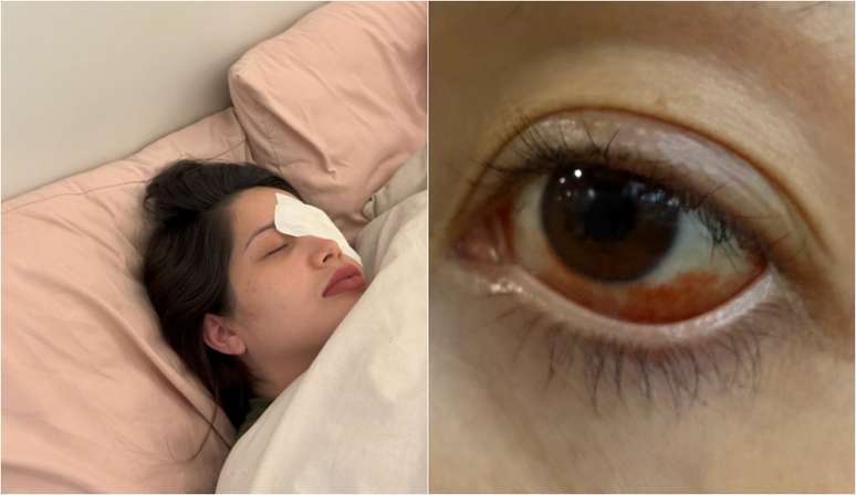 “I was very afraid of being blind,” said the influencer who suffered from the bleeding of the eyes after wearing expired lenses