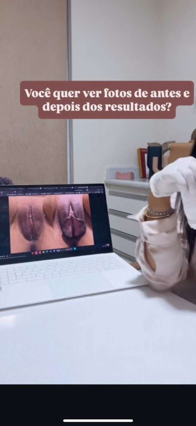 Liziane Lopes Ramalho, m&atilde;e da influenciadora Vanessa Lopes, mostra resultado de cirurgia &iacute;ntima