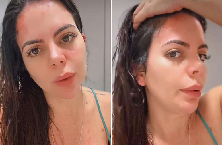 Renata Giaffredo compartilhou que se feriu com explos&atilde;o de panela de press&atilde;o