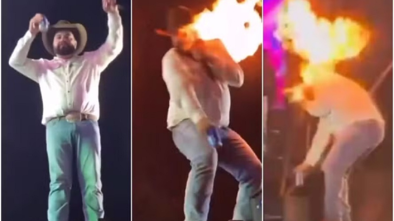 Cantor mostra como ficou o rosto após pegar fogo durante show