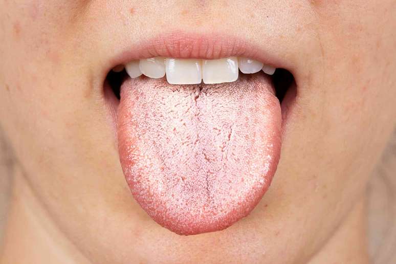 Algumas pessoas que tomam o medicamento para perda de peso apresentam um acúmulo de bactérias na língua. sruilk/ Shutterstock