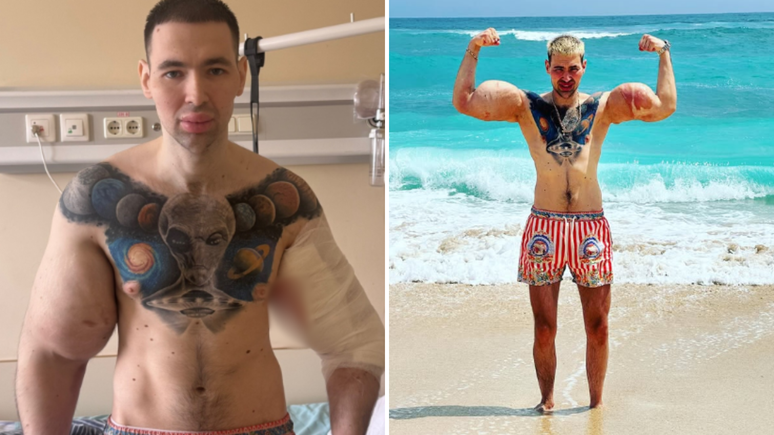 Influencer conhecido como 'Popeye Russo' é hospitalizado para ‘retirar bíceps’