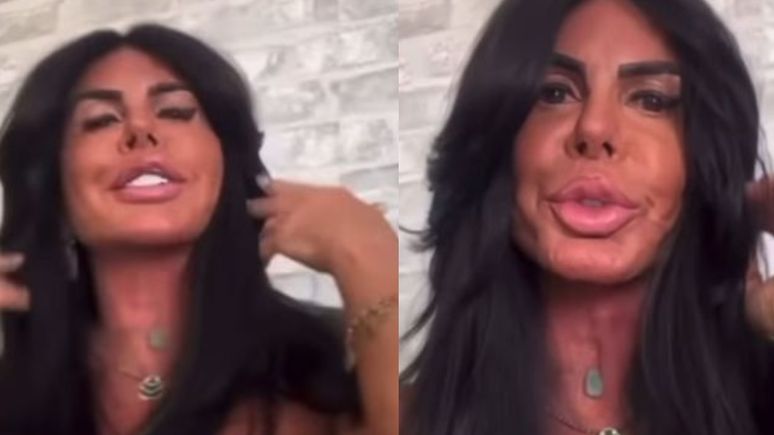 Gretchen faz novo procedimento no rosto e surpreende com o resultado
