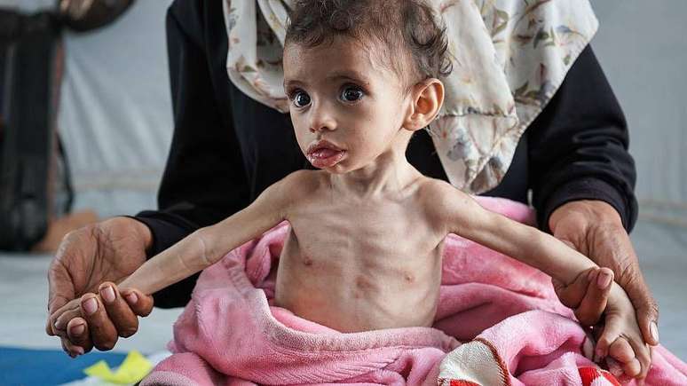 Um menino de 11 meses com desnutri&ccedil;&atilde;o em Gaza em junho de 2025. Sem a entrada de ajuda em massa, mais de 70 mil crian&ccedil;as com menos de cinco anos v&atilde;o sofrer de desnutri&ccedil;&atilde;o grave nos pr&oacute;ximos meses, informou a ONU em maio