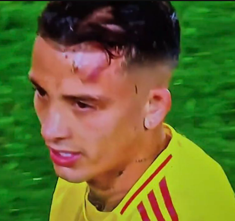 Jogador colombiano ficou machucado depois do choque
