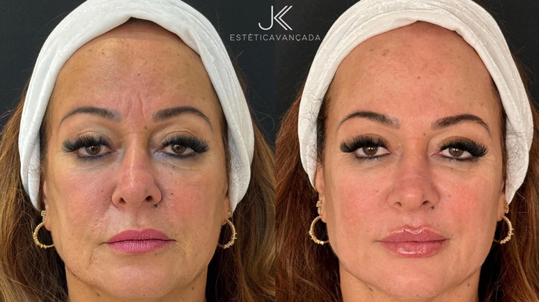 Nadine Gonçalves passa por rejuvenescimento facial