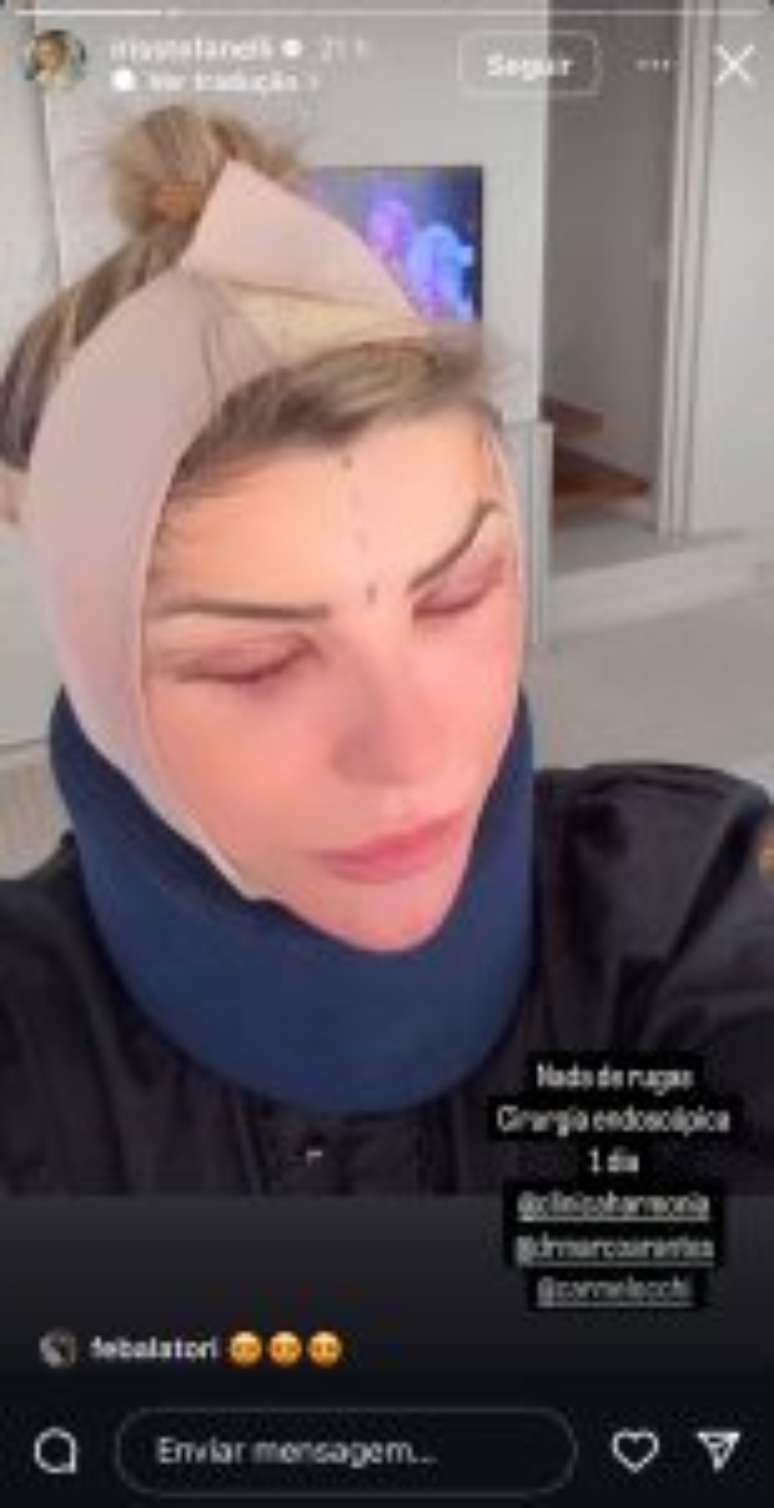 Iris Stefanelli mostra resultado de cirurgia plástica