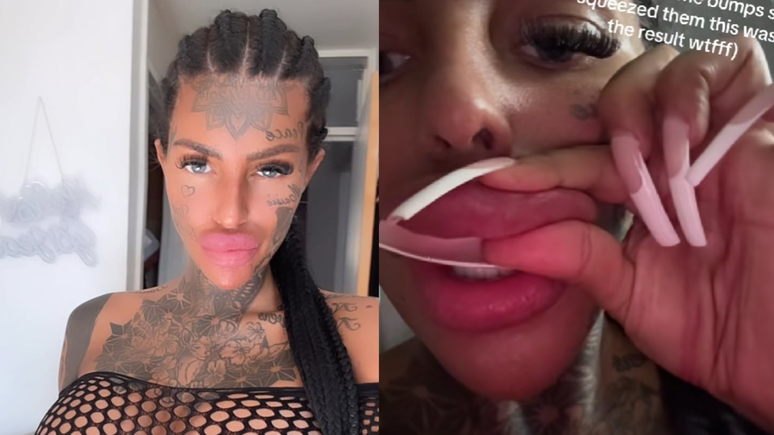 Influenciadora britânica mostra preenchimento vazando dos lábios