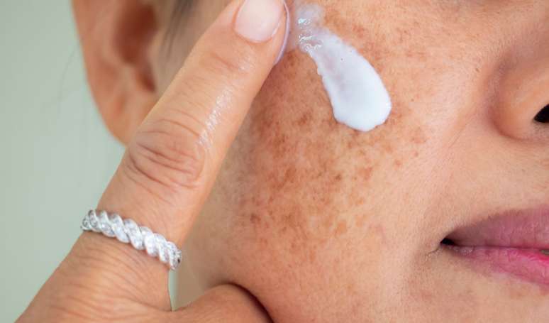 Melasma: the expert reveals that the mild climate and the lowest exposure to the sun in the winter treatments in favor; See how to take care of the skin