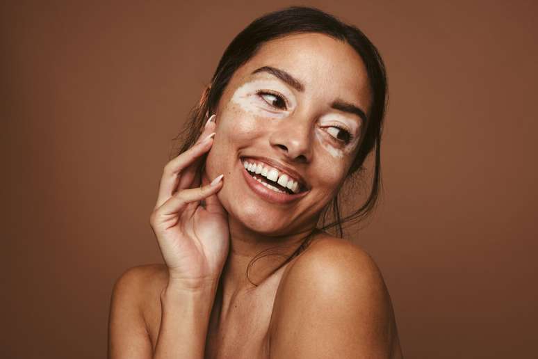 Vitiligo is a disease that has no known forms of prevention Vitiligo is a disease that has no known forms of prevention