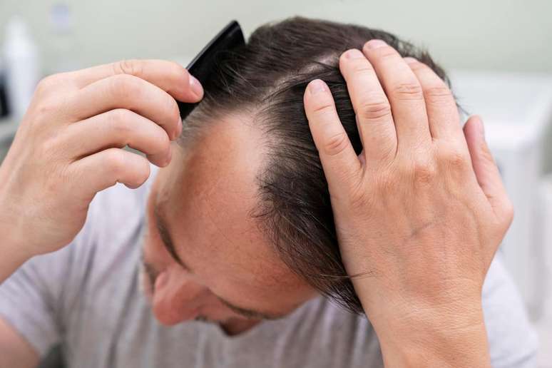 Thin: how medicine works to fight baldness