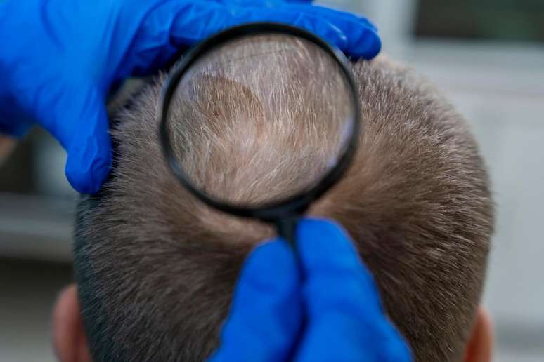 The new technique treats hair falls with the patient’s blood The new technique treats hair falls with the patient’s blood