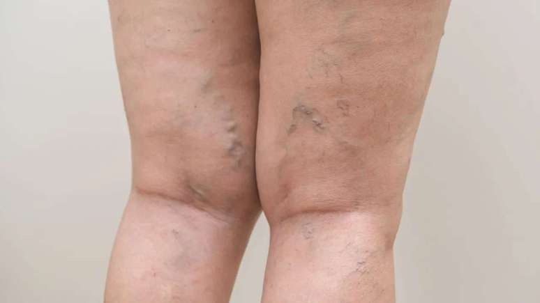 Varicose veins: 5 tips to take care of symptoms in winter
