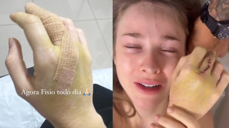 Sammy Sampaio shows surgical points in his right hand