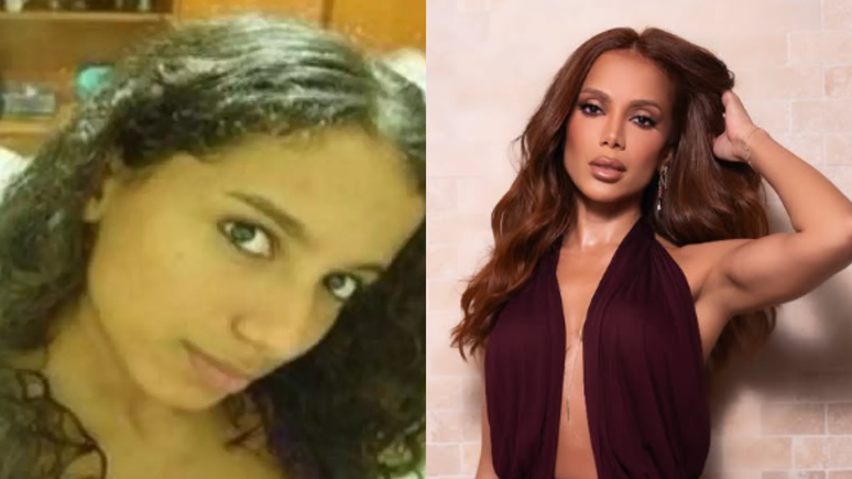 Mudou muito? Saiba quantos procedimentos estéticos Anitta já fez