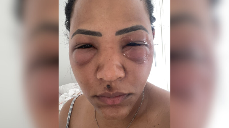 “My eye was huge”: the woman has a serious infection after error in the application of hyaluronic acid on dark glasses