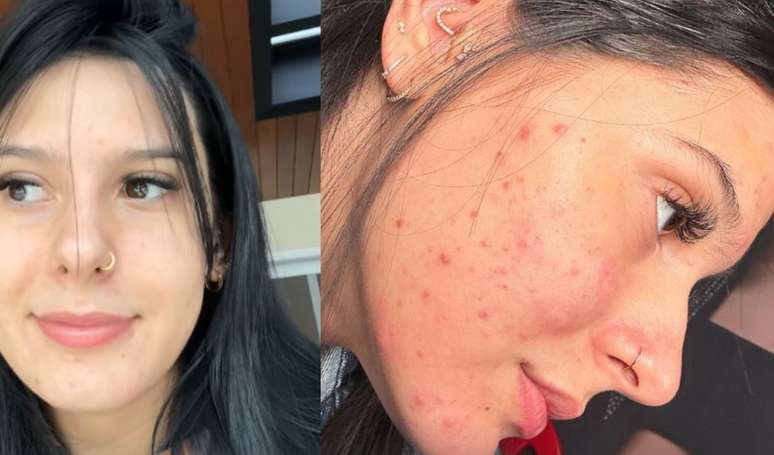 Medical warns after Ana Castela reveals the use of Roacutan; Learn potential side effects and restrictions on use
