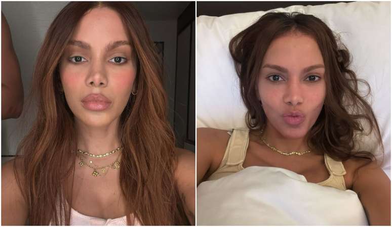 Anitta did you do what in the face? Specialist gives hypotheses