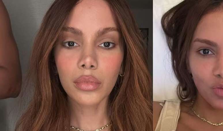 Exaggerated? After the “unrecognizable” face of Anitta, an expert warns the risks of aesthetic procedures before 35