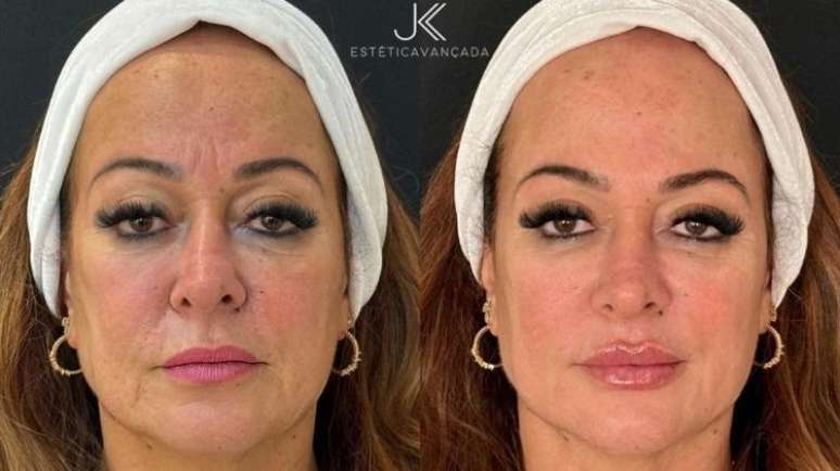 M&atilde;e de Neymar, Nadine realizou um procedimento de rejuvenescimento facial