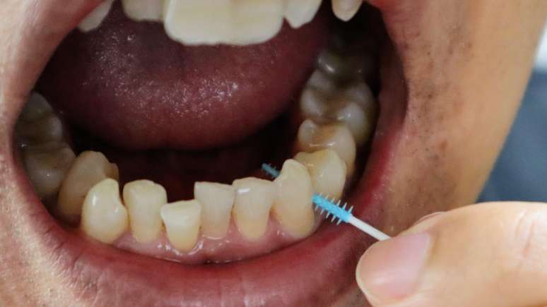 Ben interdental brushes remove the bacterial plate, where they cannot obtain ordinary teeth brushes Ben interdental brushes remove the bacterial plate, where they cannot obtain ordinary teeth brushes