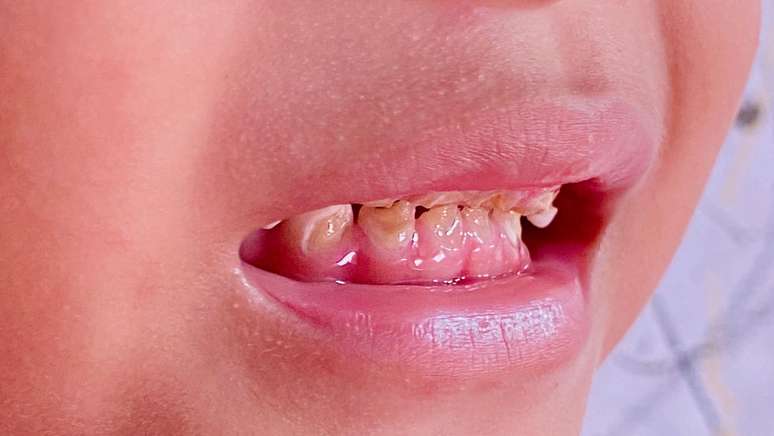 The consumption of excess foods and sugary drinks can cause cavity in children and adults The consumption of excess foods and sugary drinks can cause cavity in children and adults