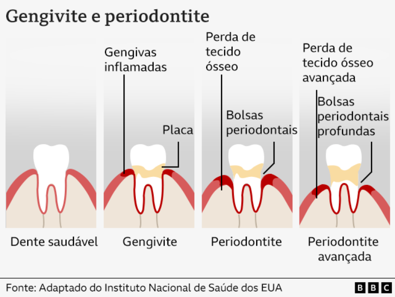 A graph that shows how the gingival disease develops in healthy teeth A graph that shows how the gingival disease develops in healthy teeth