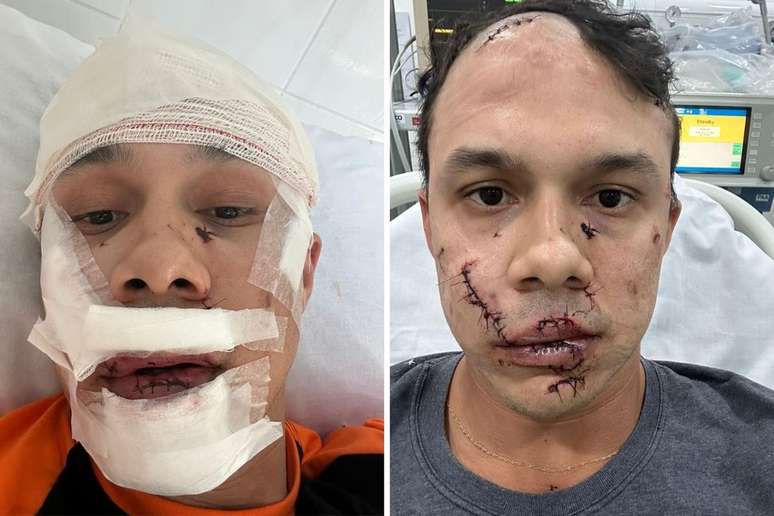 O personal Thiago Medeiros Ribeiro Mendes levou 45 pontos no rosto ap&oacute;s agress&otilde;es com um copo de vidro em bar de &Aacute;guas de Lind&oacute;ia (SP) &mdash;