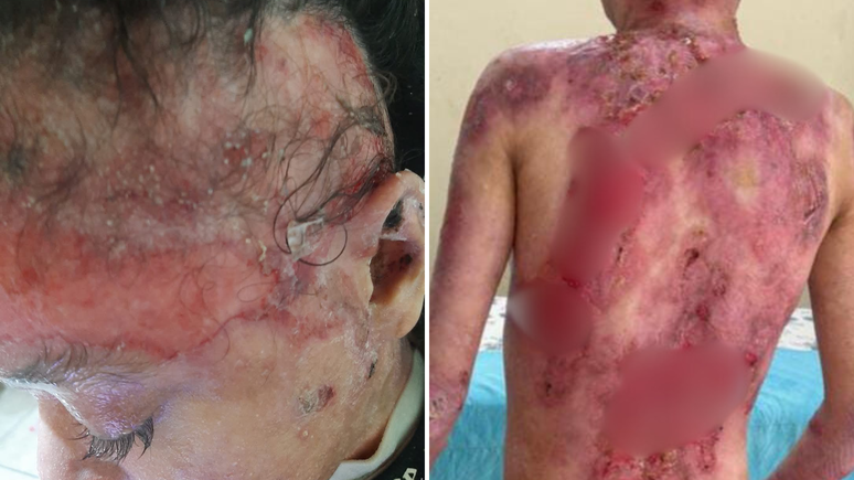 A avó Marli Perpétua dos Santos Teixeira, de 55 anos, explica que são necessárias várias camadas do insumo e eles precisam ser não aderentes à pele. Caso não, grudam nos ferimentos e causam dor e perda de sangue em Elena. 