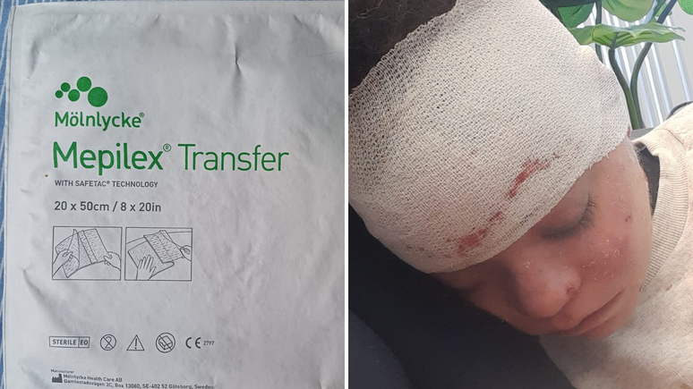 Devido à condição, que causa uma fragilidade na pele e nas mucosas, a jovem lida com a formação constante e dolorosa de bolhas e lesões e, por isso, precisa de um curativo específico e prescrito para o seu tipo de pele chamado "Mepiflex Transfer"