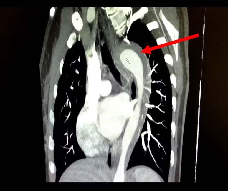 The woman suffers her aorta from aorta during orgasm in a rare case