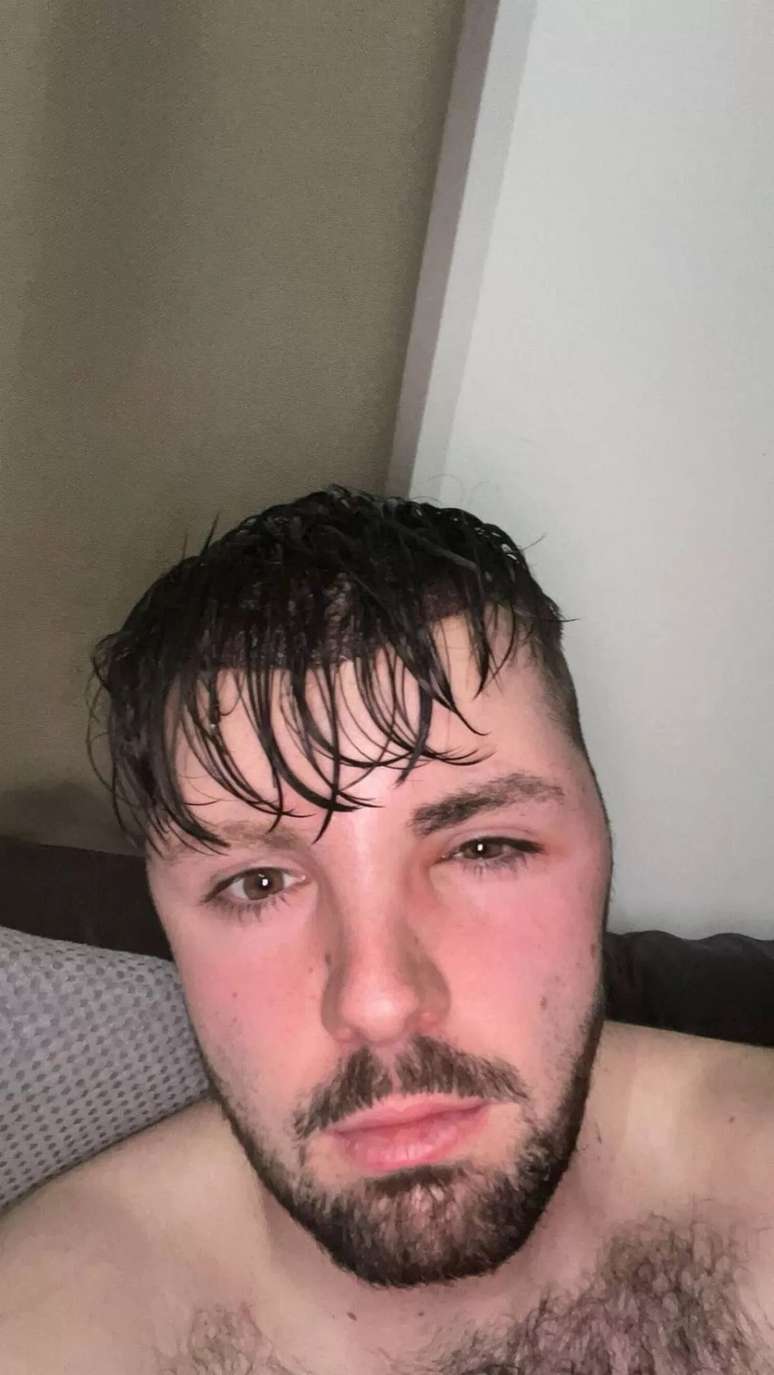 Ruben Owen shows the results after going against postoperative medical recommendation Ruben Owen shows the results after going against postoperative medical recommendation