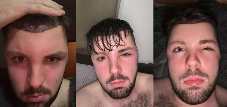 The man has a deformed face after ignoring the post-surgical medical recommendation