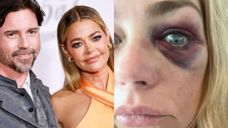 Denise Richards exibe marcas da agress&atilde;o