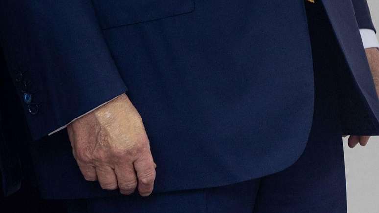 Hematoma in Trump's hand