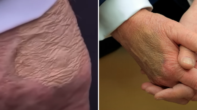 Before the diagnosis, Trump was captured with makeup and inflated feet