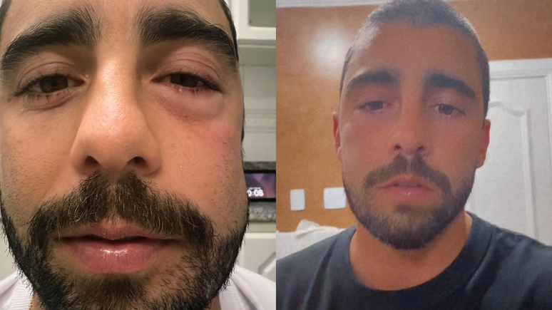 Pedro Scooby appears with a swollen face after the procedure and scares the followers; Learn the reason