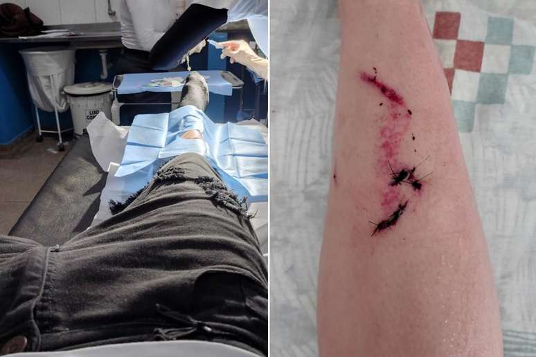 The student was one of the injuries in the decline in the stands before the show by Gian and Giovani in Eldorado (SP) and took eight points in the leg - The student was one of the injuries in the decline in the stands before the show by Gian and Giovani in Eldorado (SP) and took eight points in the leg -