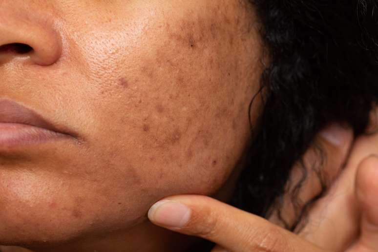 Can melasma get worse in winter? Can melasma get worse in winter?
