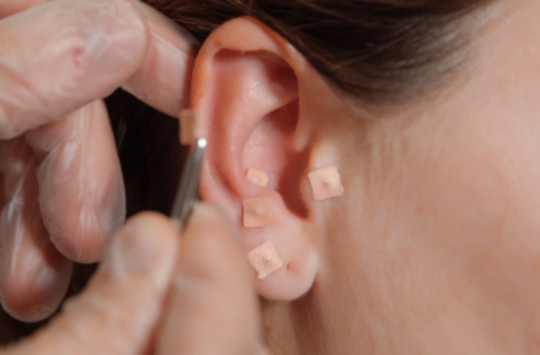Auriculoterapia